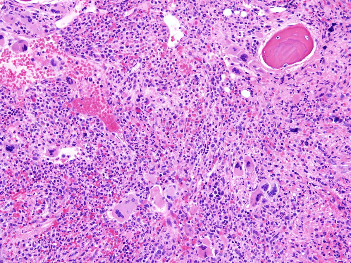 Note the increased abnormal megakaryopoiesis and increased granulopoiesis 